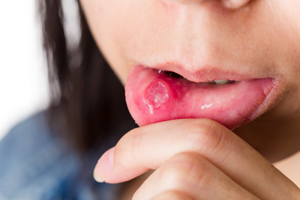 New Year, Fresh Smile: The Basics of Preventing Oral Thrush - Dr. B Dental Solutions