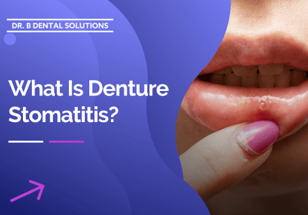 What Is Denture Stomatitis ? - Dr. B Dental Solutions